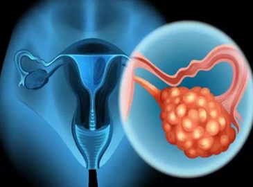 遗传性乳腺癌和卵巢癌基因检测